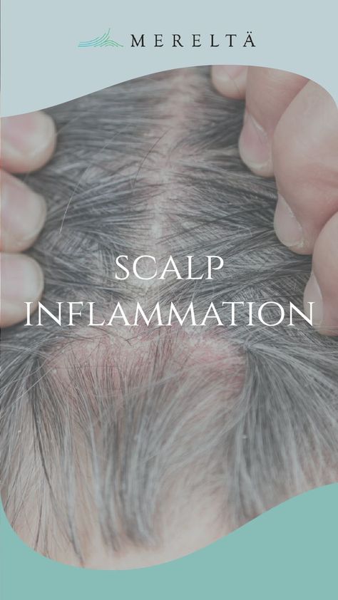 Scalp Inflammation How To Reduce Dandruff, Dry Scalp Remedy, Inflammation Remedies, Home Remedies For Dandruff, Dandruff Remedy, Clean Scalp, Getting Rid Of Dandruff, Hair Dandruff, Dandruff Shampoo