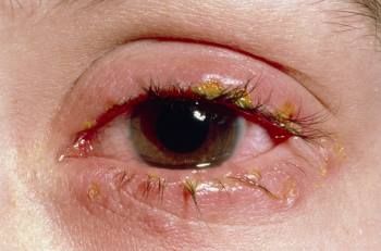 Pink Eye Infection, Pink Eye Relief, Pink Eye Remedy How To Get Rid Of, Conjuctivita Eye, Eye Infection Symptoms, Stye Remedy, Crusty Eyes, Pink Eye Remedy, Eye Stye Remedies