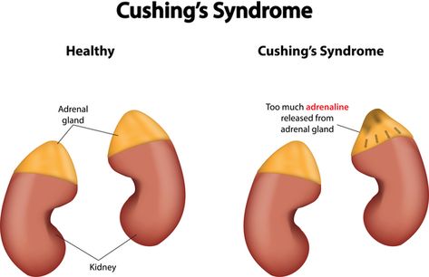 Cushing disease - Genetics Home Reference Cushing’s Syndrome, Cushings Disease, Low Thyroid Remedies, Thyroid Remedies, Cushings Syndrome, Foot Reflexology Massage, Adrenal Glands, Adrenal Fatigue, Endocrine System