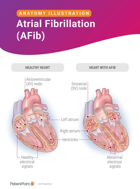 Atrial Fibrillation PatientPoint Anatomy Illustration, Atrial Fibrillation, Family Caregiver, Cardiology, Questions To Ask, Heart Healthy, Anatomy, Medicine