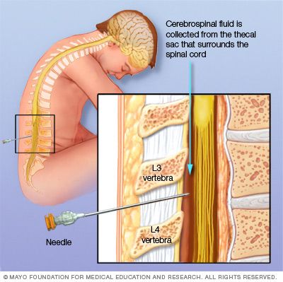 Illustration of lumbar puncture (spinal tap) Spinal Tap, Spinal Fluid, Interventional Radiology, Brain Surgeon, Cerebrospinal Fluid, Medical School Essentials, Medical Anatomy, Medical Studies, Spinal Cord