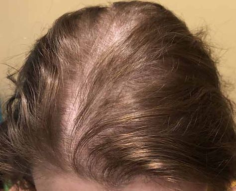 Telogen Effluvium, Homemade Hair Mask, Hairstyles Art, Biology Facts, Unwanted Facial Hair, Homemade Hair Products, Stimulate Hair Growth, Hair Restoration, Garden Care