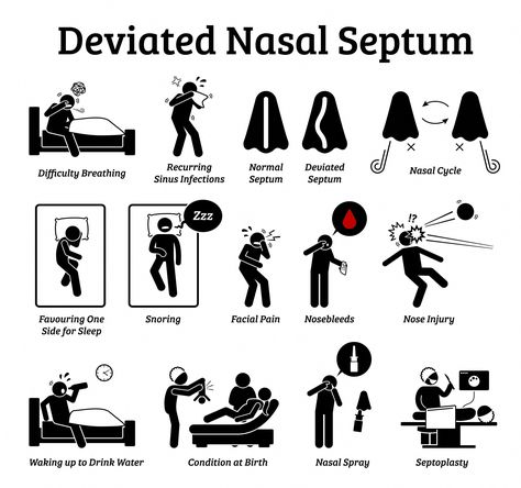 This Digital Drawings & Illustrations item by LeremyStickFigures has 7 favorites from Etsy shoppers. Ships from United States. Listed on Aug 14, 2023 Reduction Rhinoplasty, Deviated Nasal Septum, Nose Operation, Nose Problems, Remedy For Sinus Congestion, Home Remedies For Sinus, Nasal Septum, Accident Injury, How To Stop Snoring