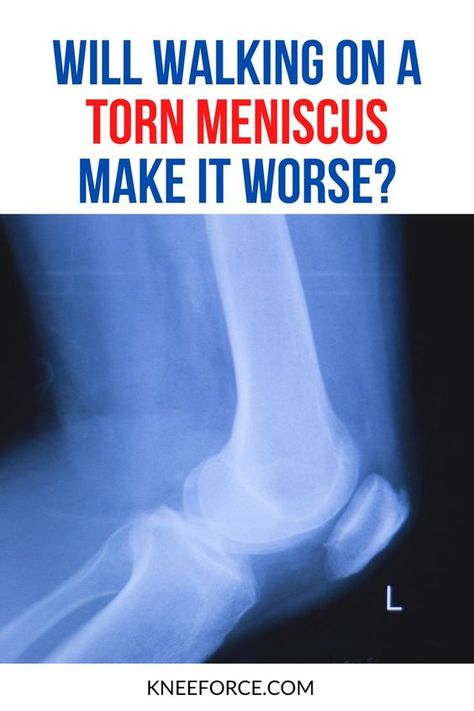 You know how to sit, stand, and sleep with a meniscus injury… But will walking on a torn meniscus make it worse? Not necessarily! This will depend on the location of the tear, its pattern, your symptoms, and several other factors. Meniscus Repair Surgery Recovery, Torn Medial Meniscus Relief, Torn Medial Meniscus Exercises, Meniscus Rehab Exercises, Torn Medial Meniscus, Meniscus Pain Relief, Kinesio Taping Knee, Meniscus Surgery Recovery, Medial Meniscus