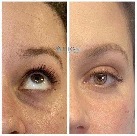 Undereye Fillers Before And After, Under Eye Filler, Undereye Filler Before And After, Under Eye Filler Before And After, Fillers Before And After, Botox Under Eyes, Under Eye Fillers, Facial Fillers, Under Eye Wrinkles