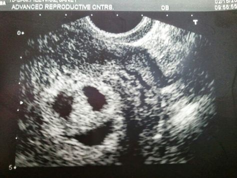 My triplet ultrasound Quadruplets Ultrasound, Triplets Ultrasound, Twin Ultrasound 6 Weeks, 2 Months Pregnant Ultrasound, 5 Months Pregnant Ultrasound, Baby Ultrasound, Ultrasound, Family Goals