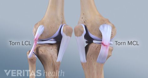 Lateral collateral ligament (LCL) tears are often seen in sports such as football and hockey, and are usually the result of a direct blow to the knee or quickly changing direction on one foot. Mcl Tear Symptoms, Mcl Tear, Sprained Knee, Knee Dislocation, Mcl Injury, Meniscal Tear, Knee Ligaments, Knee Strengthening Exercises, Anterior Cruciate Ligament