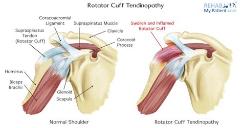 Rotator Cuff Tendinopathy | Rehab My Patient Rotator Cuff Tendinosis, Rotator Cuff Surgery, Rotator Cuff Tear, Why I Run, Biking Backpack, Olympic Weightlifting, Runners High, Rotator Cuff, Spartan Race