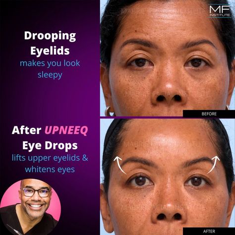 Patient Story: This hardworking patient, wanted to make sure she looked #refreshed during her meetings!

Solution: Outside of #fillers and #BOTOX Dr. Mabrie felt that #UPNEEQ drops could really give it that extra PZAZZ. 

How it works: 
Upneeq is by prescription-only
Results visible in 15 mins, but may vary
Average upper eyelid lift with Upneeq in clinical studies was 1mm
Dosage = 1 drop per eye / per day
Can be used by contact wearers.

#eyelidlift #nonsurgicallidlift Upneeq Before And After, Whiten Eyes, Drooping Eyelids, Droopy Eyelids, Eyelid Lift, Upper Eyelid, Facial Plastic, Eye Lift, Eye Drops