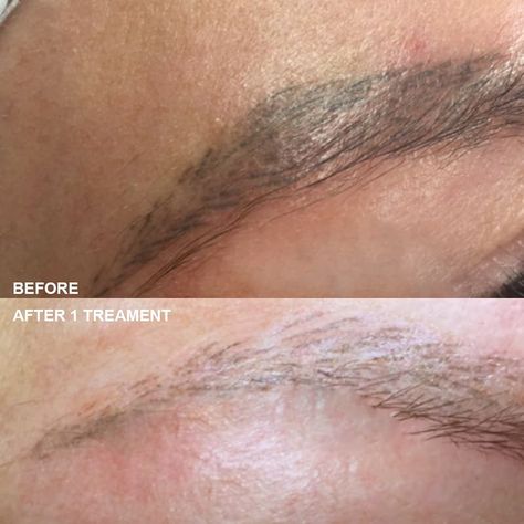 Remove Eyebrow Tattoo, Eyebrow Tattoo Removal, Microblading Eyebrows, Eyebrow Tattoo, Healthy Beauty, Tattoo Removal, Microblading, Healthy Skin, Follow Us