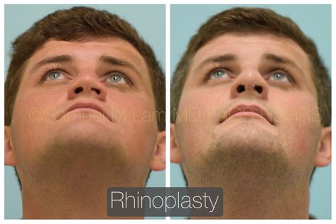 This 25-year-old man had trauma to his nose from sports as a teenager. He had difficulty breathing from the left side of his nose and did not like how asymmetric his nasal tip, bridge, and nasal base appear. He also has a saddle nose deformity with a collapse nasal bridge. He underwent a rhinoplasty and is shown before and one week after his rhinoplasty with good aesthetic improvement. Nose Job Taping, Nose Job Droopy Tip, Men Rhinoplasty, Nasal Tip Rhinoplasty, Men Nose, Rhinoplasty Before After Dorsal Hump, Good Aesthetic, Nose Jobs, Rhinoplasty Surgery