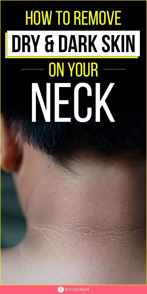 Diy Dark Spot Remover Under Arms, Neck Scrub Dark, How To Remove Dark Spots On Neck, Neck Discoloration Remedies, How To Whiten Neck, How To Remove Dark Neck Remedies, Clean Neck Skin, How To Clean Dark Neck, Hyperpigmentation On Neck