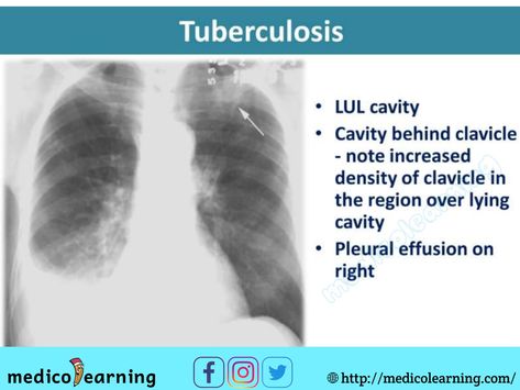 Chest X-ray interpretation Respiratory Therapy Notes, Chest Xray, Medical Radiography, Radiology Student, Medical Mnemonics, Radiology Imaging, Radiology Tech, Medical Pictures, Radiology Technologist