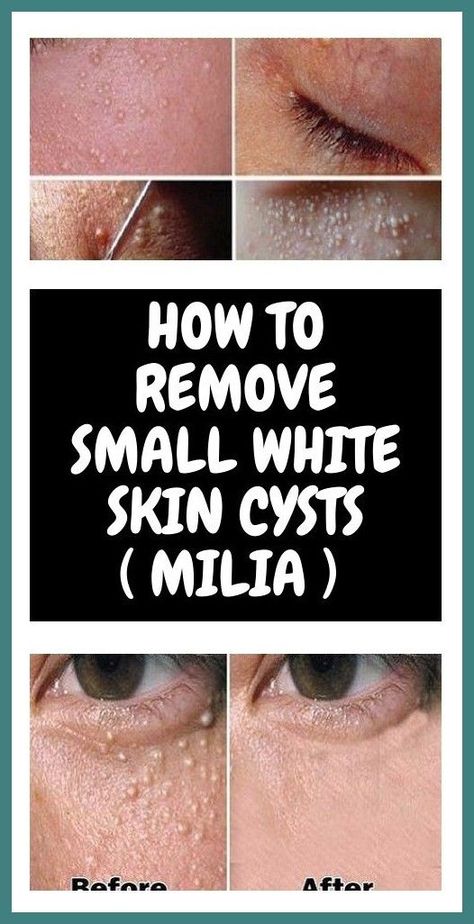 #cyst #fibroid #senggugut #pimple #acne #pimplepopping #blackhead #blackheads #pimplepopper #pimples White Skin, Health And Fitness Tips, Health Advice, Wellness Tips, Healthy Tips, Blackheads, Back Pain, Beauty Health, Fitness Tips