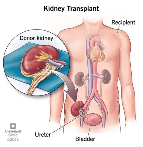 Kidney Transplant: Surgery, Purpose, Procedure & Recovery Kidney Donor, Healthy Kidneys, Infection Prevention, Blood Donor, Preventive Medicine, Surgery Recovery, Cleveland Clinic, Kidney Health, Medical Illustration