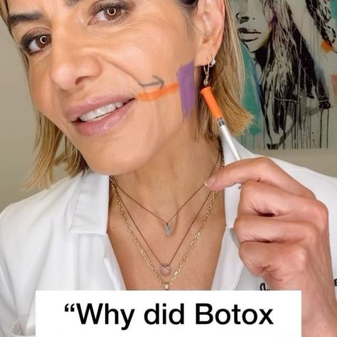 LLSAN = Levator Labii Superioris Alaeque Nasi 2-6 units to each LLSAN and 4-8 units for lip flip #gummysmile #gummysmiletreatment… | Instagram Botox Training, Teeth Clenching, Lip Flip, Botox Brow Lift, Teeth Grinding, Gummy Smile, Grinding Teeth, Brow Shaping, Med Spa