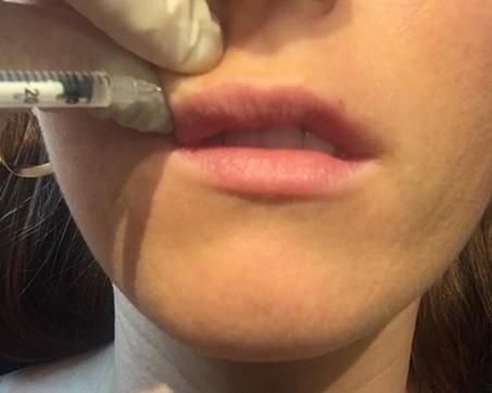 Lip Injections Small Lips, Lip Flip And Filler Before And After, Best Lip Plumper Before And After, Upper Lip Filler Before And After, How To Make Upper Lip Look Fuller, Before And After Lip Flip, Botox Lips Before And After, Lip Flip Results, Lip Botox Before And After