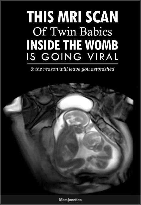 This MRI Scan Of Twin Babies Inside The Womb Is Going Viral. And The Reason Will Leave You Astonished #Pregnancy Twins In The Womb, Baby In The Womb, Baby Inside, Mri Scan, Mom Junction, Going Viral, Natural Birth, Forensic, Twin Babies