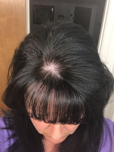 Thanks Monat for the bald spot!  You suck! Bald Spot, Long Hair Styles, Hair Styles, Hair, Beauty