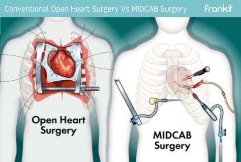 Heart Hospital, Human Body Facts, Surgical Technologist, Medical Videos, Open Heart Surgery, Cardiac Nursing, Heart Anatomy, Bypass Surgery, Medicine Student