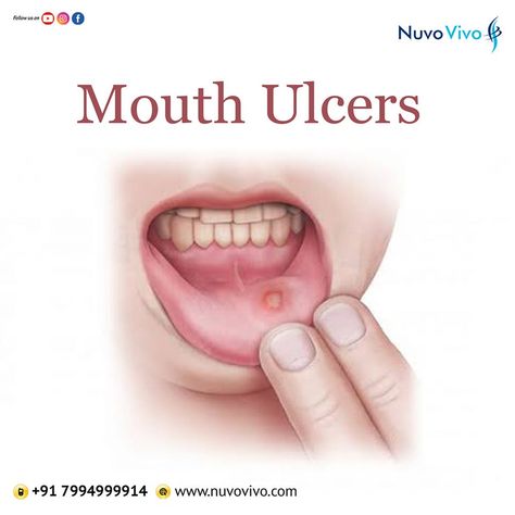 Mouth ulcers (Canker sores) are those painful lesions that occur on the gum, inside of the lips and other areas of the mouth. While most of these sores go away in a week or two, they can make drinking, eating, etc quite uncomfortable. Lifestyle Diseases, Mineral Deficiency, Canker Sore, Irritable Bowel, Food Allergy, Lack Of Sleep, Food Allergies, Allergies, Disease