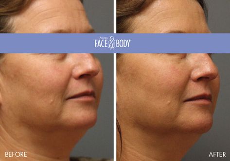 Have you heard of the "Triangular Face of Youth"? Women in their 20’s & 30s, have a  triangular face that is considered a youthful shape. As we continue to age, however, we find that the triangle inverts–so instead of highlighting the cheeks in an upward direction, the emphasis shifts downward. Our #TransformationTuesday focuses on the liquid facelift which uses fillers & neurotoxins to lift & contour facial features without surgery. Call (678 )888-3223 to set up your free consultation! Lift Contour, Liquid Facelift, Facial Contouring, Platelet Rich Plasma, Baby Fat, The Triangle, Facial Features, Dermal Fillers, Transformation Tuesday