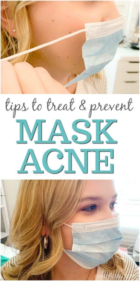 Mask acne, or mascne has become a real problem for people that are wearing facemasks for long periods of time. Facial skin can be very sensitive, and can breakout easily. Here are some easy tips and tricks to show you how to prevent mask acne that can really help minimize mask related breakouts. Mask Acne, Lotion For Oily Skin, Oily Skin Acne, Tips For Oily Skin, Moisturizer For Sensitive Skin, Anti Wrinkle Skin Care, Acne Face Mask, Skin Care Wrinkles, Moisturizer For Oily Skin