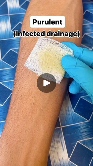 693K views · 4.5K reactions | Wound drainage types | follow the_nursing_coach #NursingCareers #woundhealing #woundcare #knowyourworth #knowledgeispower #nursingeducation #NCLEX #nclexreview #fundamentalofnursing #nursingknowledge | the_nursing_coach | Suriel Hess · Little Bit More Wound Healing Nursing, Skin Integrity And Wound Care Nursing, Wound Care Nursing Documentation, Wound Description Nursing, Wound Care Nursing, Np School, Nclex Review, Wound Care, Wound Healing