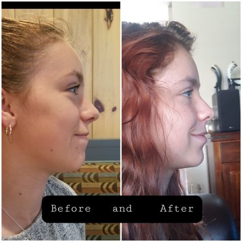 Before and after jaw surgery pics of face shape Jaw Surgery, Side Profile, Face Shape, Face Shapes, Surgery, Siding, Quick Saves