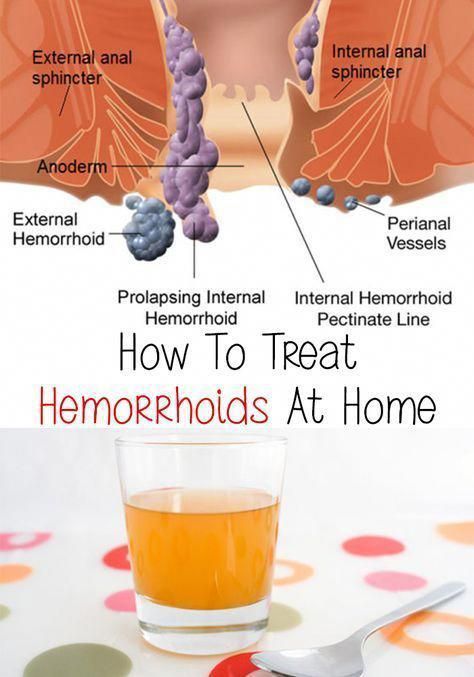 What Causes Piles, Piles Remedies, Hemorrhoid Remedies, Heal Thyself, Constipation Remedies, Homemade Remedies, Alternative Health, Homeopathy, Cider Vinegar