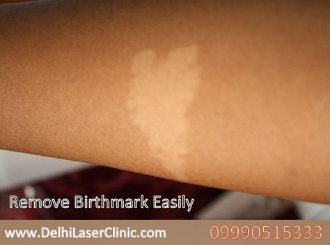 Do you have birthmark on your body, which you try to hide sometimes. Want to get rid of birth mark, contact to Delhi Laser Clinic - +91-9990515333  Know more about birthmark removal process. Birthmark Meaning, Stomach Hair, Birthmark Removal, Birth Marks, Fake Marriage, Remove Skin Tags Naturally, Hair Removal Diy, Beauty Marks, Tag Remover