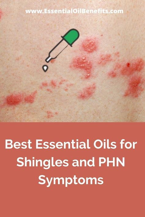 Healthy Nails Remedies Oils For Shingles, Shingles Remedies, Essential Oils For Shingles, Treating Shingles, Essential Oils Recipes, Nail Remedies, Doterra Recipes, Top Essential Oils, Essential Oil Benefits