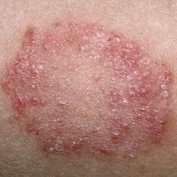 How To Treat Ringworm Fungal Rash, Ring Worm, Yeast Infection Causes, Varicose Vein Removal, Vein Removal, Skin Rashes, Fungal Infection, Skin Disorders, Nail Fungus