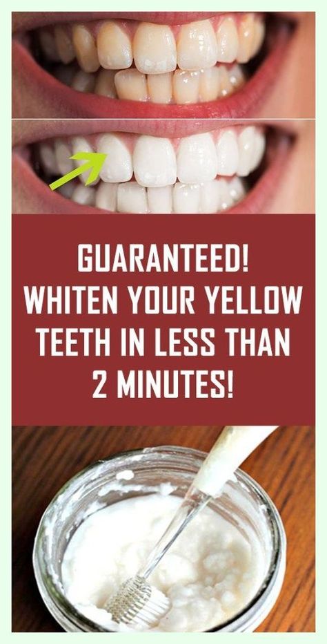 GUARANTEED! Whiten Your Yellow Teeth In Less Than 2 Minutes! Teeth Whitening Homemade, Teeth Whitening Diy, Yellow Teeth, Teeth Health, Best Teeth Whitening, Natural Teeth Whitening, Natural Teeth, White Teeth, Oral Health