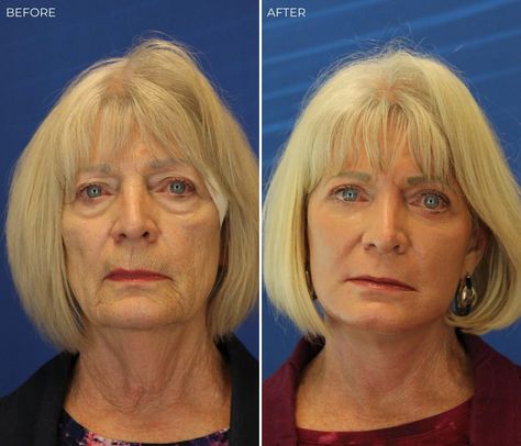 Skin Resurfacing Before And After, Erbium Laser Resurfacing, Laser Resurfacing Before And After, Fraxel Laser, Erbium Laser, Face Laser, Laser Peel, Facial Procedure, Laser Skin Resurfacing