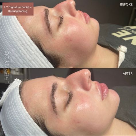 What is Dermaplaning? Dermaplaning At Home Step By Step, Derma Planing Face, How To Do Dermaplaning At Home, At Home Dermaplaning Facial, Best Dermaplaning Tool, Cystic Acne, Layers Of Skin, Chemical Peel, Broad Spectrum Sunscreen