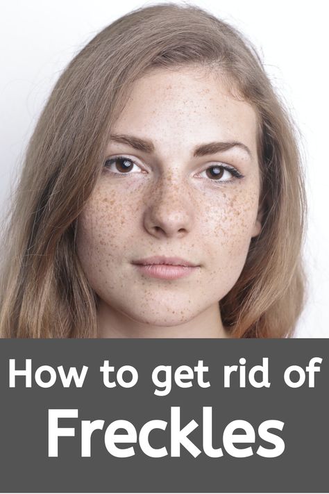 How To Get Rid Of Freckles, How To Remove Freckles, Getting Rid Of Freckles, Freckle Remover, Diy Remedies, Daily Skin Care Routine, Beauty Secrets, Natural Skin, Skincare Routine