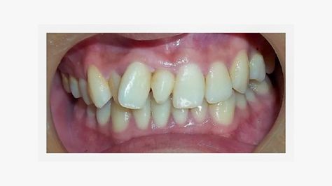 Mesiodens (Extra Tooth) Causes and Why It Should Be Treated Extra Teeth, Impacted Tooth, Nasal Obstruction, Tooth Infection, Dental Insurance Plans, Wisdom Teeth Removal, Tooth Removal, Dental Veneers, Dental Procedures