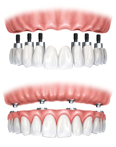 Dental Images, Dental Implant Procedure, Denture Implants, Best Dental Implants, Dental Implant Surgery, Dental Implants Cost, Implant Dentistry, Emergency Dentist, Teeth Implants