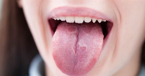 From a dry, sticky coating to small round lesions, discolored taste buds to pockets of pus, there are many reasons why the tongue can appear white. The fade from pinkish-red can occur overnight or develop slowly over time. Sometimes there's soreness, but not always. Dental Smile, Lichen Planus, White Tongue, Signs Of Inflammation, Mouth Rinse, Reading Is Fundamental, Chronic Obstructive Pulmonary Disease, Vitamin Deficiency, Tongue Health