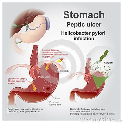 Eptic ulcer disease, also known as a peptic ulcer or stomach ulcer, is a break in the lining of the stomach, first part of the small intestine, or occasionally the lower esophagus.An ulcer in the stomach is known as a gastric ulcer while that in the first part of the intestines is known as a duodenal ulcer. Stomach Ulcers Symptoms, Ulcer Symptoms, Ulcer Diet, Small Intestine, Gastrointestinal System, Back Pain Remedies, Stomach Ulcers, Educational Infographic, Acid Reflux