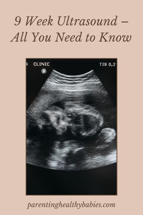 In the 9 week ultrasound, you can see the foetus which is now the size of a cherry with an approximate height of 0.9 inches and 0.07 ounces weight. Here are 9 Week Ultrasound – All You Need to Know. #ultrasoundatweek9ofpregnancy #week9ofpregnancy #week9pregnancy #week9ultrasound 9 Weeks Pregnant Ultrasound, 9 Week Ultrasound, Nine Weeks Pregnant, 9 Weeks Pregnant, 15 Weeks Pregnant, Pregnancy Ultrasound, Pregnancy Week, Ultrasound Pictures, Baby Images