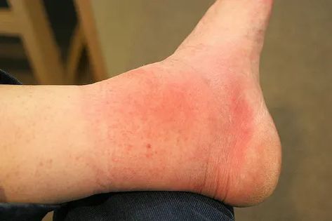 Natural Remedy For Infected Bites And Wounds - HubPages Infected Bug Bite, Bug Bite Swelling, Spider Bites Pictures, Fire Ant Bites, Bug Bites Remedies, Ant Bites, Red Ant, Tick Bite, Swollen Ankles