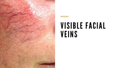 Why Are The Veins On My Face So Visible - Vein Solutions Veins On Face, Facial Veins, Thread Veins, Hand Veins, Visible Veins, Pine Essential Oil, Red Veins, Red Spider, Birth Control Pills