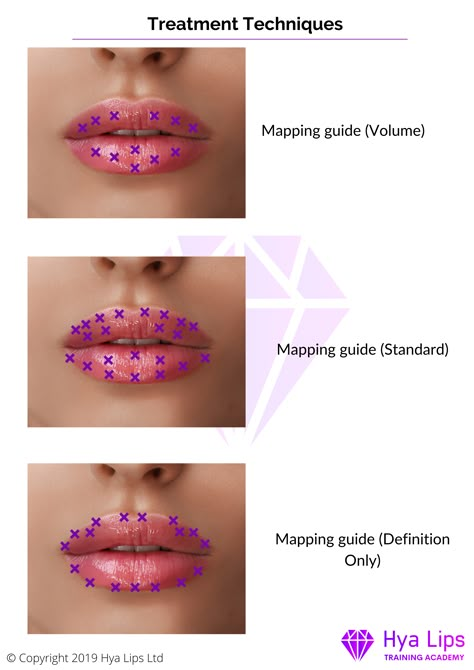 Diy Lip Plumper, Dermal Fillers Lips, Juvederm Lips, Hyaluronic Acid Lips, Cosmetic Fillers, Lips Inspiration, Botox Lips, Aesthetic Dermatology, Hyaluronic Acid Fillers