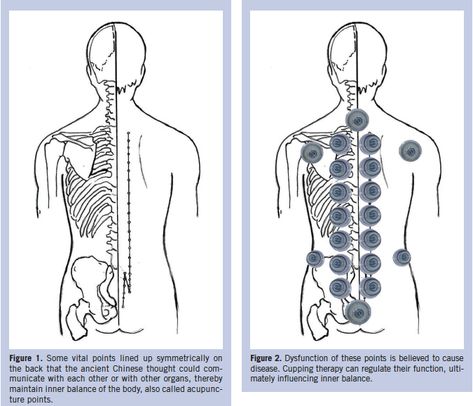 Cupping Therapy Chinese Cupping Points, Cupping Therapy Placement Chart, Cupping Therapy Advertisement, Cupping Therapy Chart Trigger Points, Cupping Placement Chart, Dry Cupping Therapy, Suction Cup Therapy, Cupping Points, Traditional Chinese Medicine Acupuncture