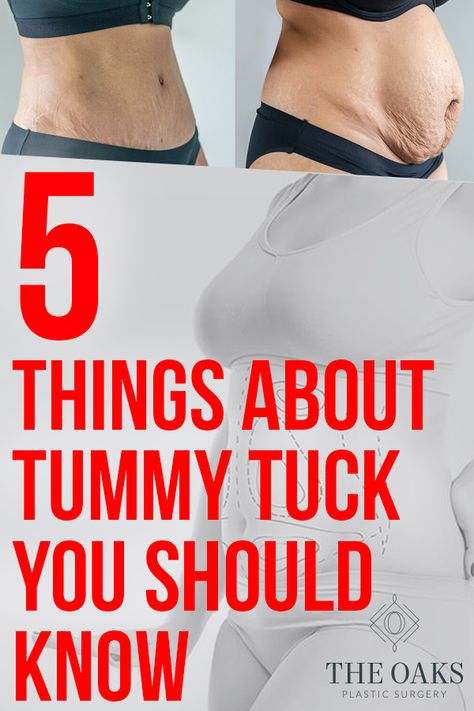 5 THINGS YOU SHOULD KNOW ABOUT TUMMY TUCK  #plasticsurgery #surgery #tummytuck #wishpic #wishpics #body #cosmetics #cosmeticsurgery #breastimplants #breastaugmentation #boobjob #mommymakeover #momlife #makeover #transformation #mommy #houston #faq #5things Abdominalplasty Before And After, Tummy Tucks 360, Yummy Tuck Before And After, Tummytuck Recovery, Tummy Tucks Recovery Timeline, Mommy Makeover Must Haves, Mommy Makeover Before And After, Tummy Tucks Recovery List, Tummy Tucks Recovery Tips