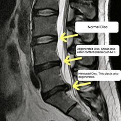 Stenosis Of The Spine, Lumbar Spondylosis, Doogie Howser, Lumbar Lordosis, Spinal Fusion Surgery, Intervertebral Disc, Spinal Fusion, Cord Blood Banking, Body Diagram