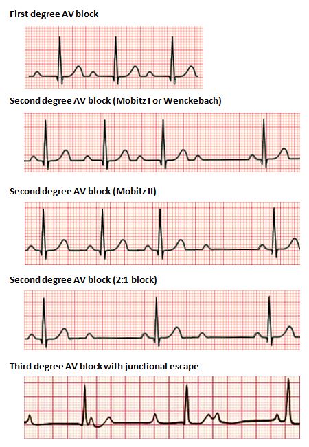 How to Interpret an ECG in Seven Steps | Online Medical Library Ekg Nursing, Ma Notes, Ekg Tech, Nursing Knowledge, Nursing Things, Ekg Interpretation, Medical Assistant Student, Pr Interval, Medical Life