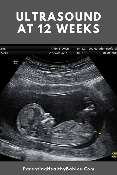 #week12ultrasound #ultrasoundat12weeks #ultrasound Ultrasound By Week, Baby Boy Ultrasound Pictures, 20 Week Ultrasound Pictures, 12 Week Ultrasound Pictures, 13 Weeks Pregnant Ultrasound, 11 Weeks Pregnant Ultrasound, 10 Week Ultrasound Pictures, 12 Week Ultrasound Gender, Ultrasound Boy Or Girl